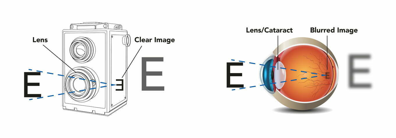 Cataract Illustration-01