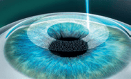 femto lasik step 1