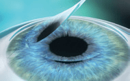 femto lasik step 2