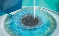 femto lasik step 3